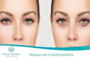 Riesgos-de-la-blefaroplastia