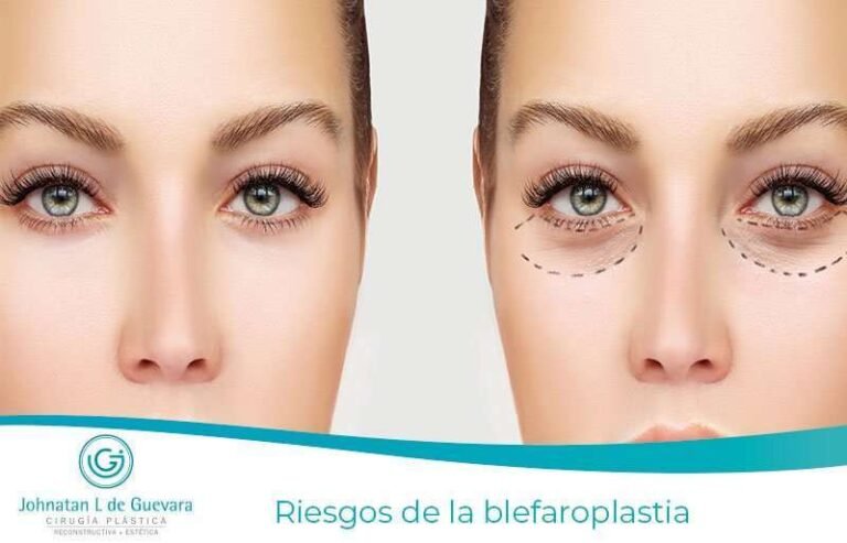 Riesgos-de-la-blefaroplastia