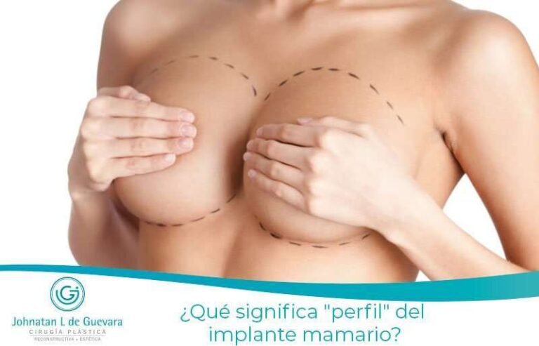 ¿Qué significa "perfil" del implante mamario?
