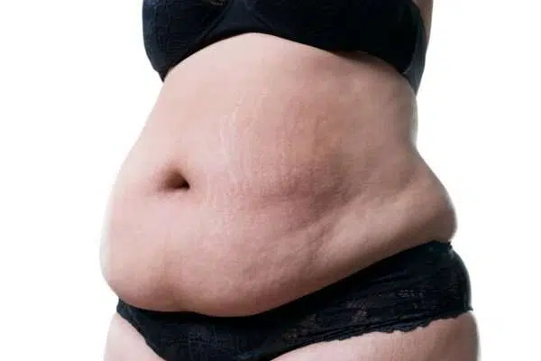 Peso ideal e IMC para la cirugía de abdominoplastia 2 Am I too fat for a Tummy Tuck?