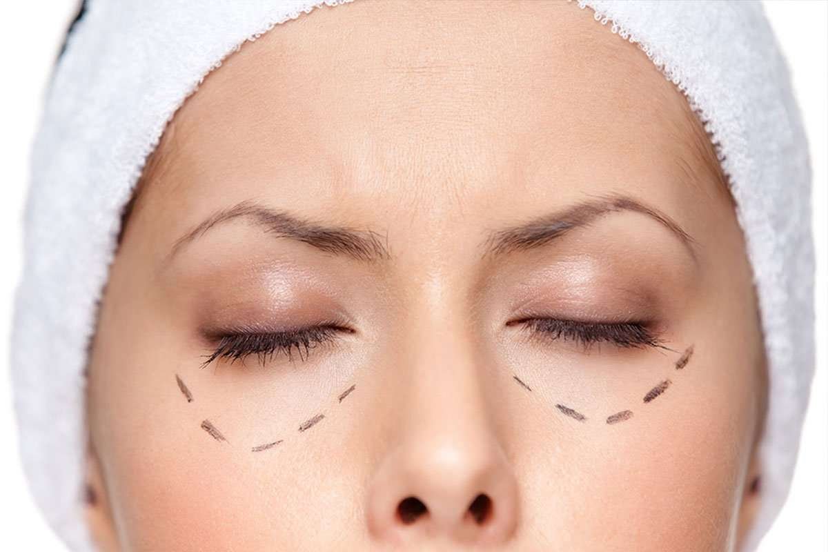 blefaroplastia sin cirugia