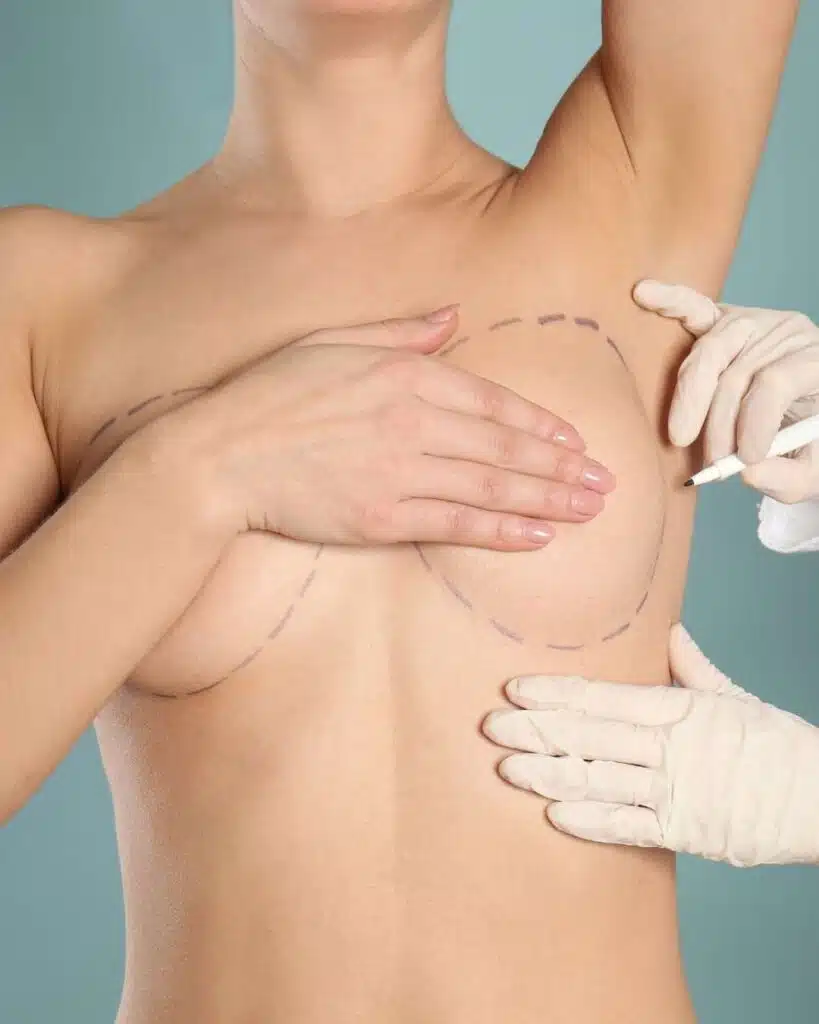 Cirugia de aumento mamoplastia