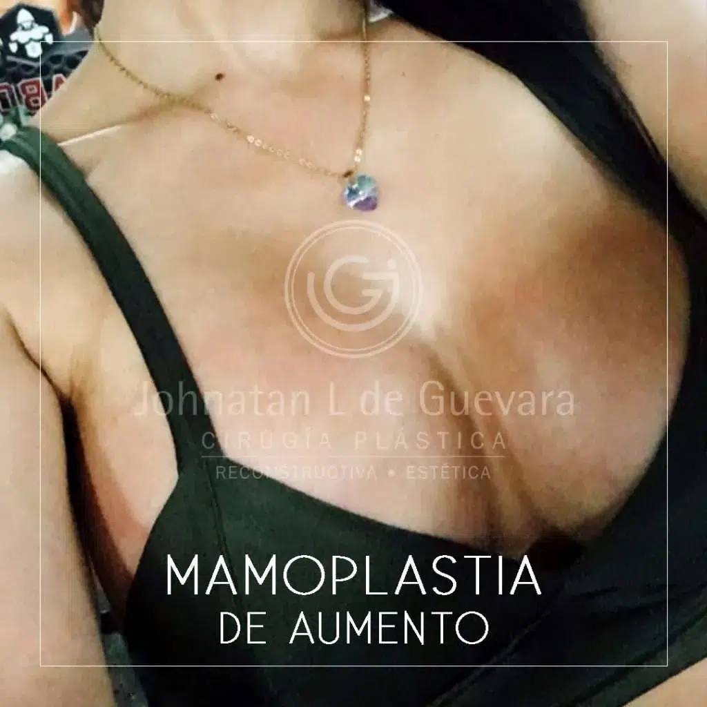fotos-antes-despues-mamoplastia-colombia-4-1024x1024