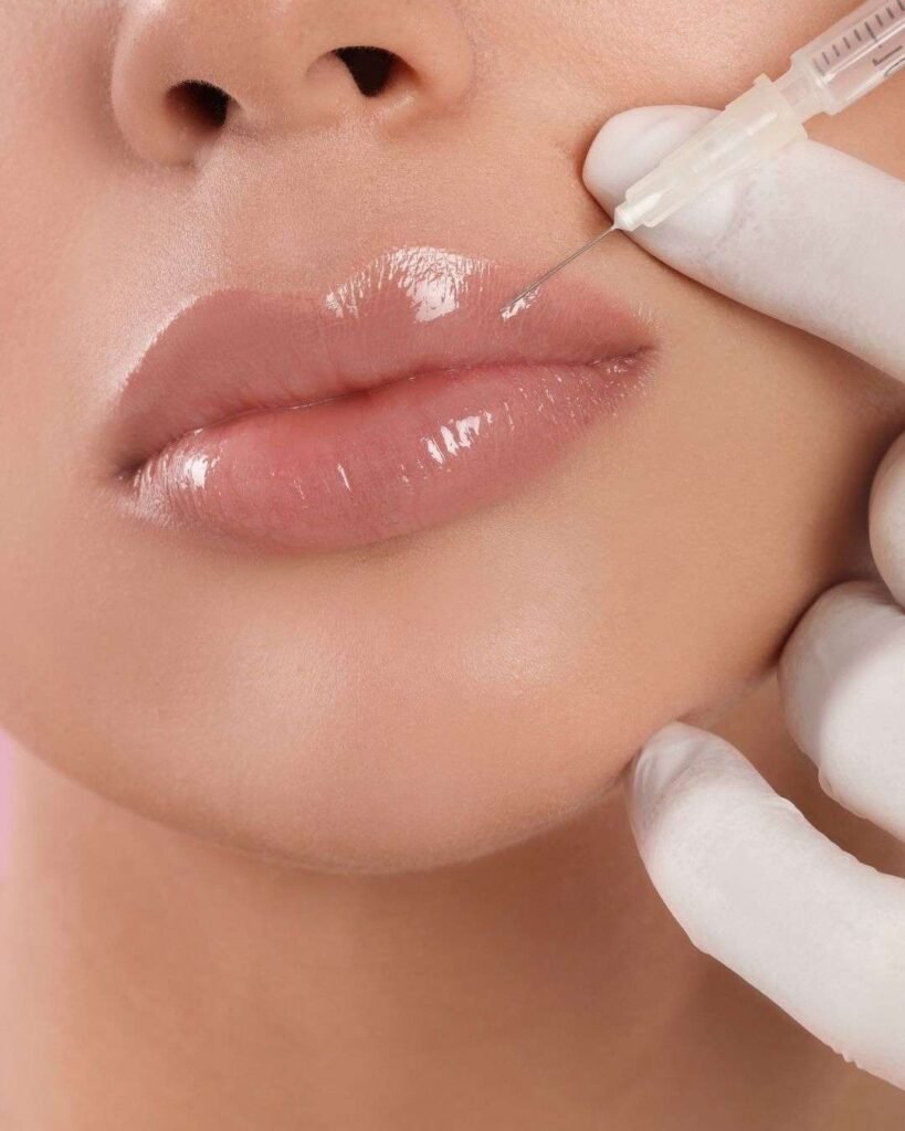 Lip augmentation 2 Aumento de Labios A - Lip augmentation