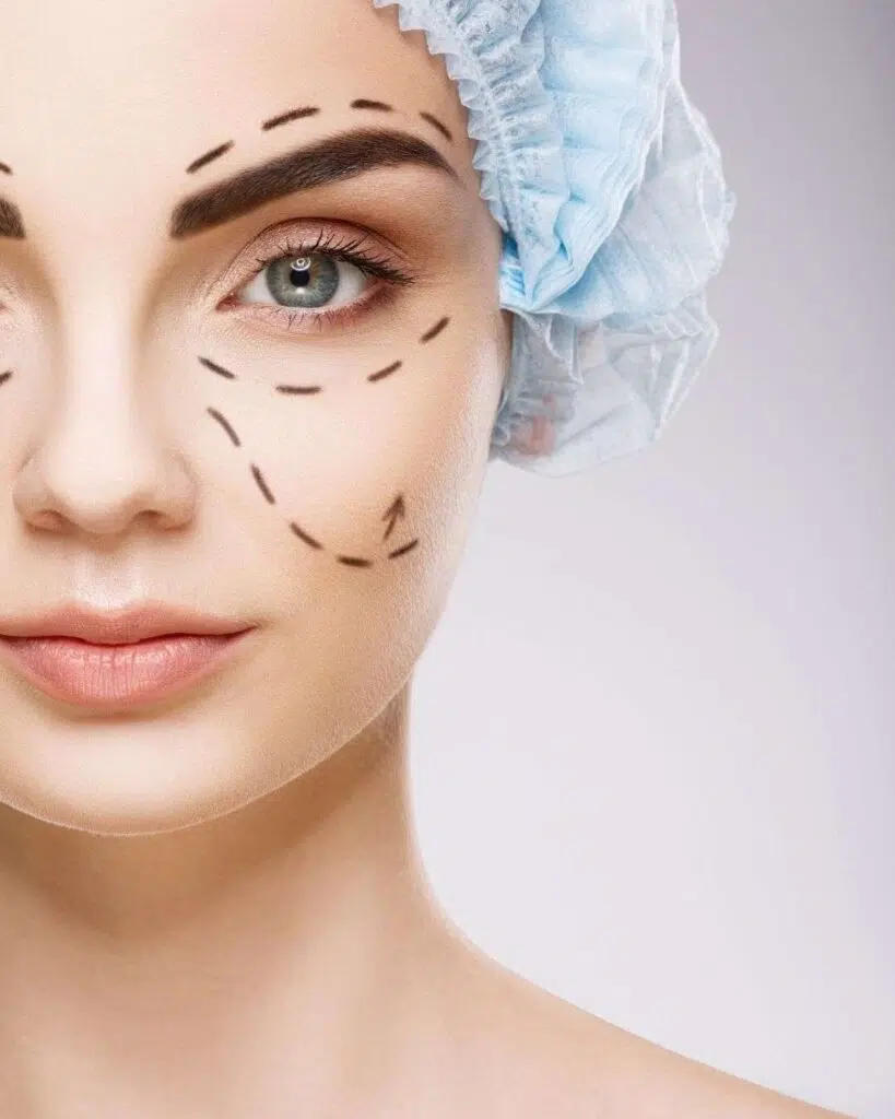 Bichectomia A 1 - Bichectomía en Bogotá