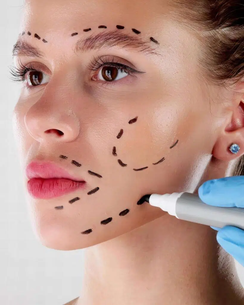 Lifting Facial A - Lifting Facial Bogotá