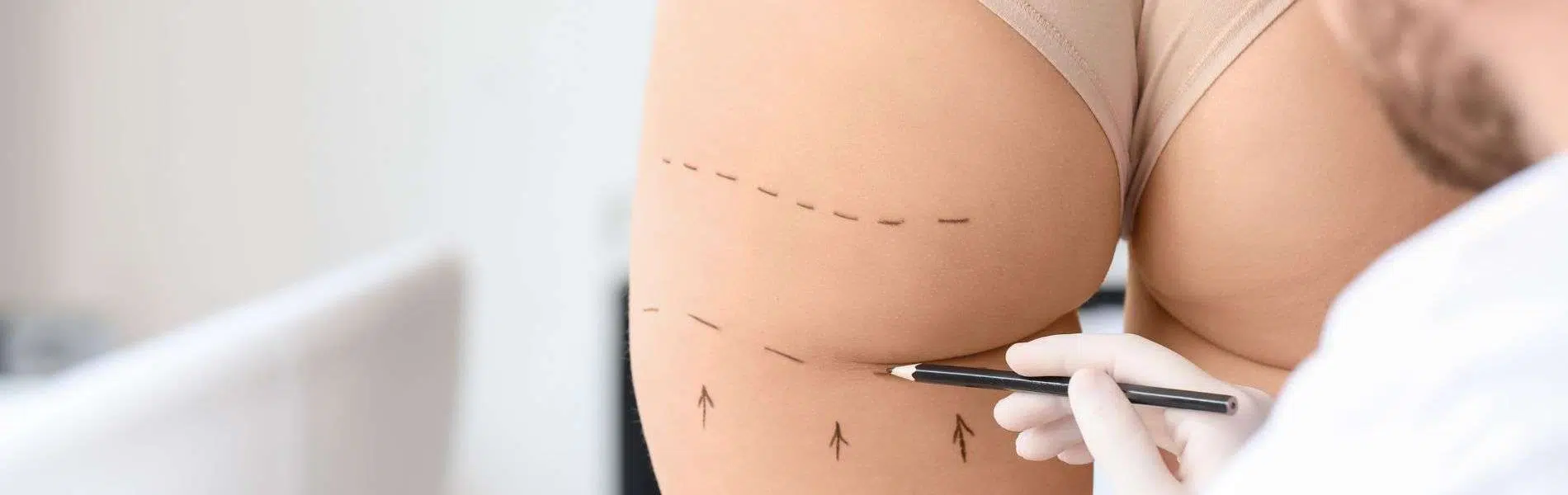 Lipoinyeccion Glutea D - Lipoinyección Glútea en Bogotá