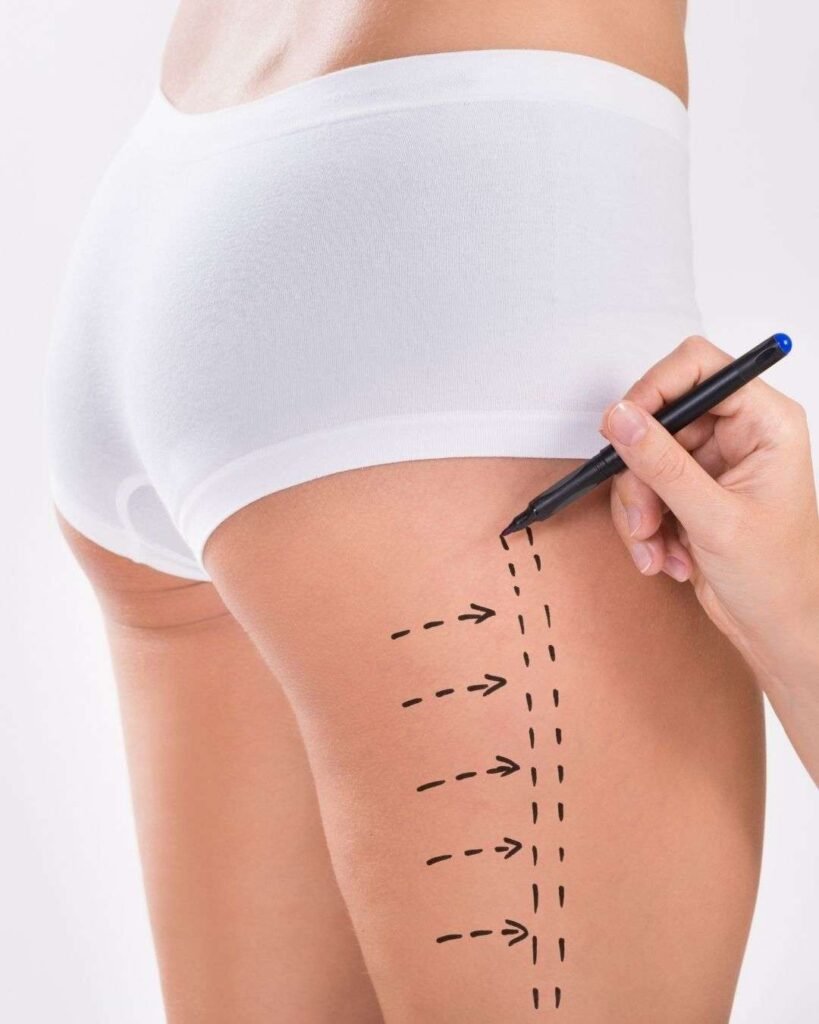 Liposuccion C - Cirugía Plástica Todo Incluido en Colombia