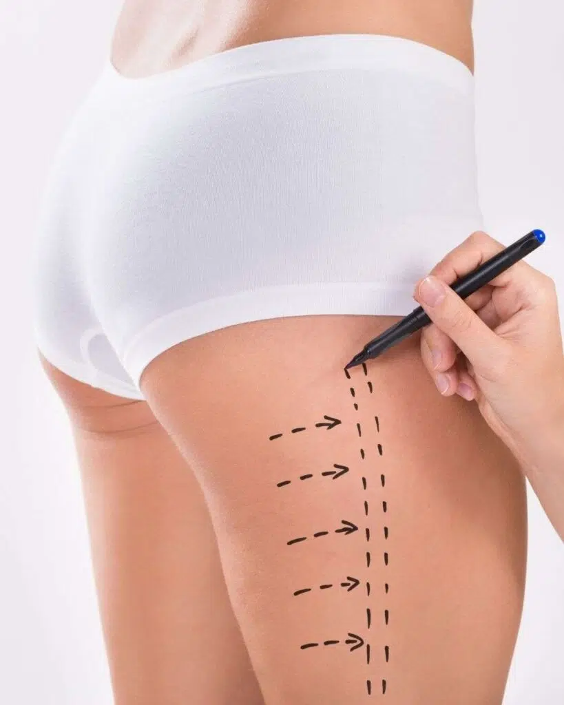 Liposuccion C - Cirugía Plástica Todo Incluido en Colombia