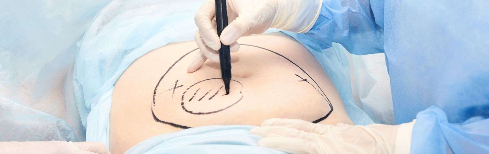 Liposuccion D - Liposuction in Colombia
