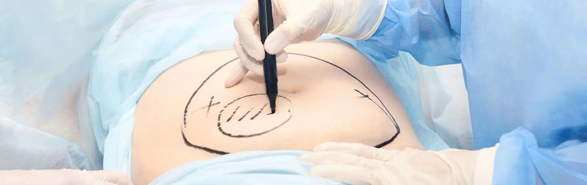 Liposucción en Bogotá 3 Liposuccion D - Liposucción en Bogotá