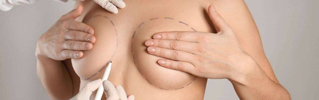 Breast Reduction Colombia 3 Mamoplastia reduccion E - Breast Reduction Colombia
