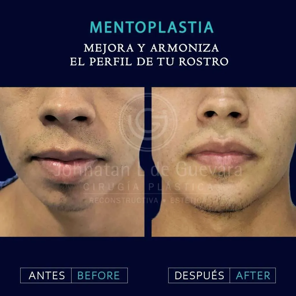 Mentoplastia 2 - Mentoplastia cirugía del mentón Bogotá