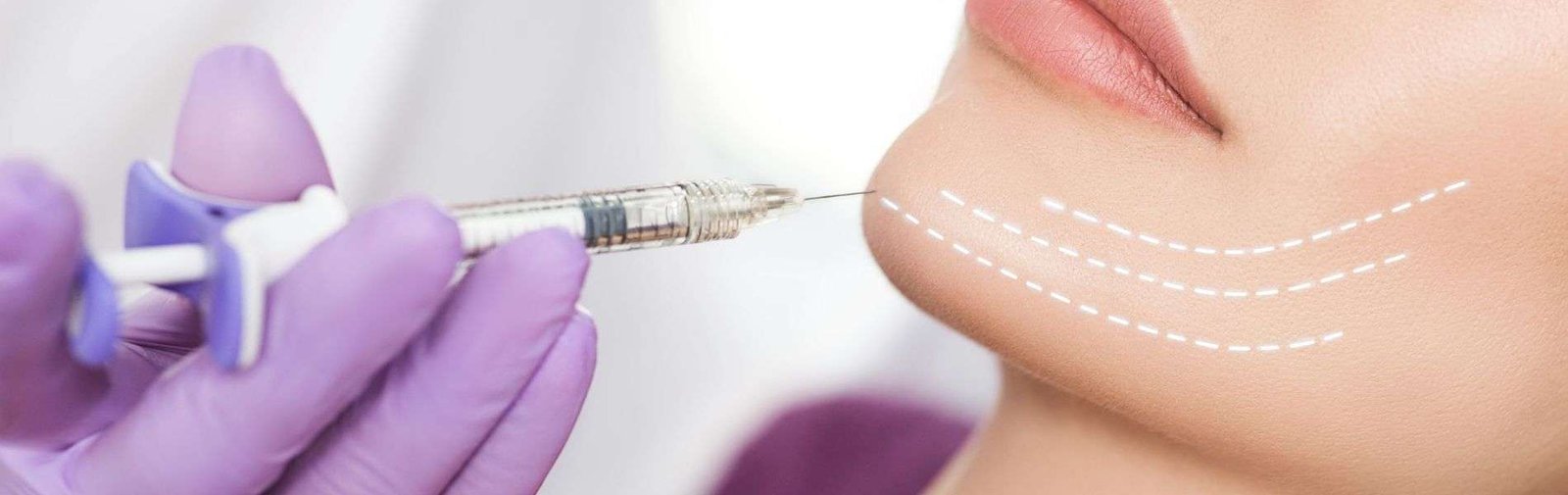 Mentoplastia C - Mentoplasty (Chin Surgery) in Colombia