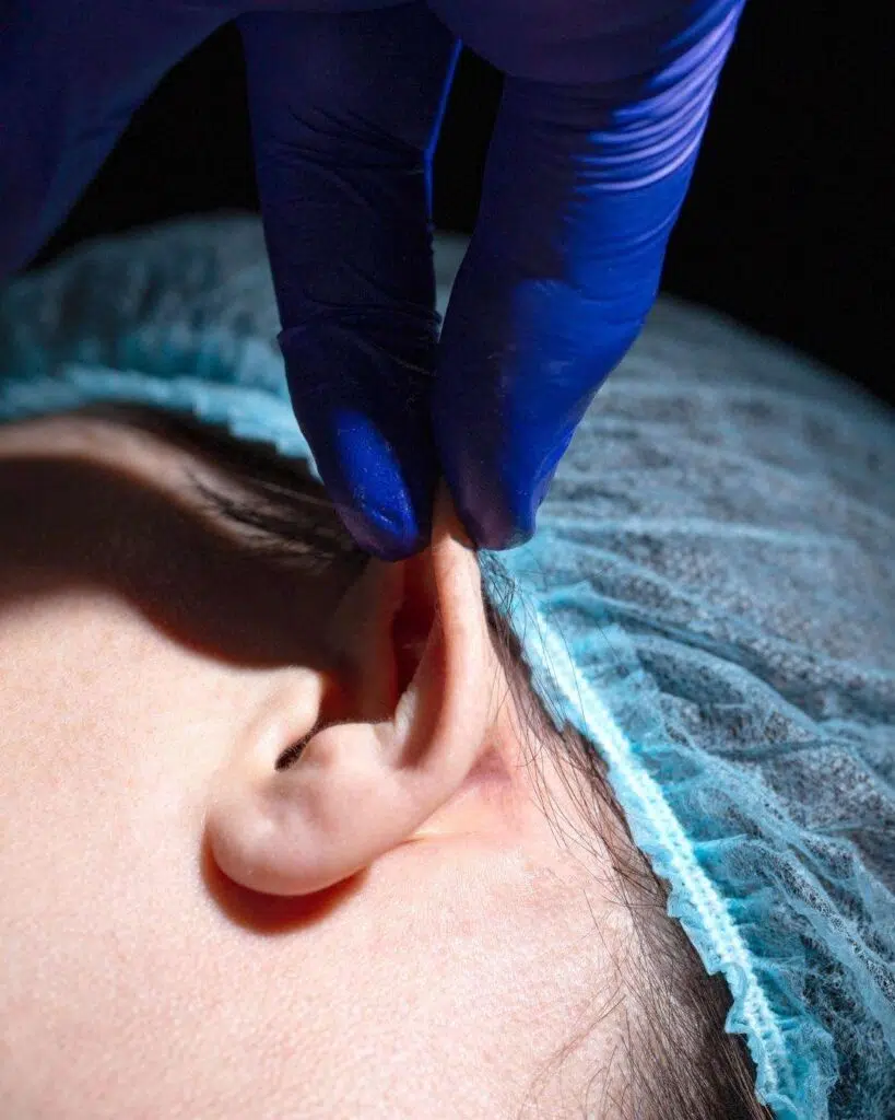 Otoplastia A - Otoplastia en Bogotá