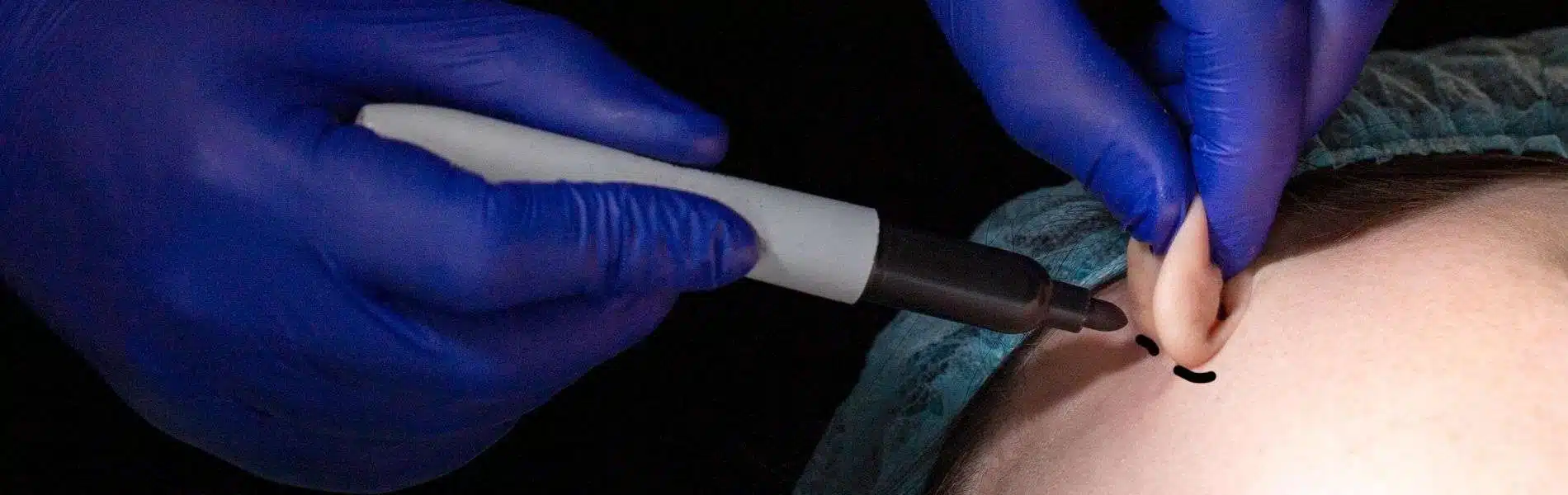 Otoplastia C - Otoplastia en Bogotá