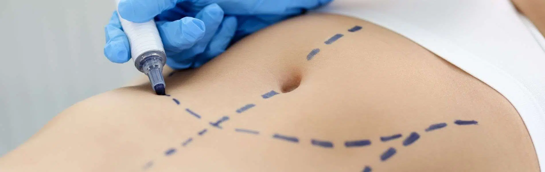 abdominoplastia D - Abdominoplastia en Bogotá