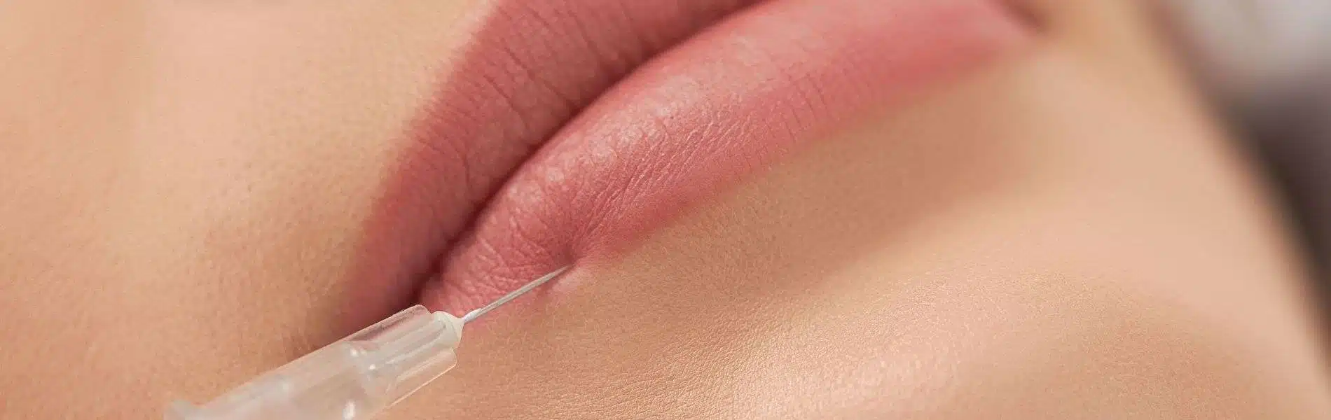 Aumento de Labios 4 Aumento de Labios D - Aumento de Labios