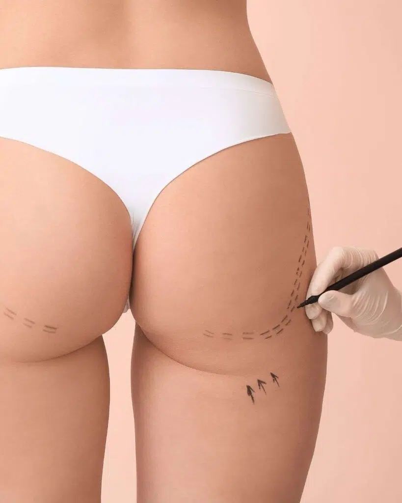 Gluteoplastía en Bogotá 2 Cirugía Gluteoplastía