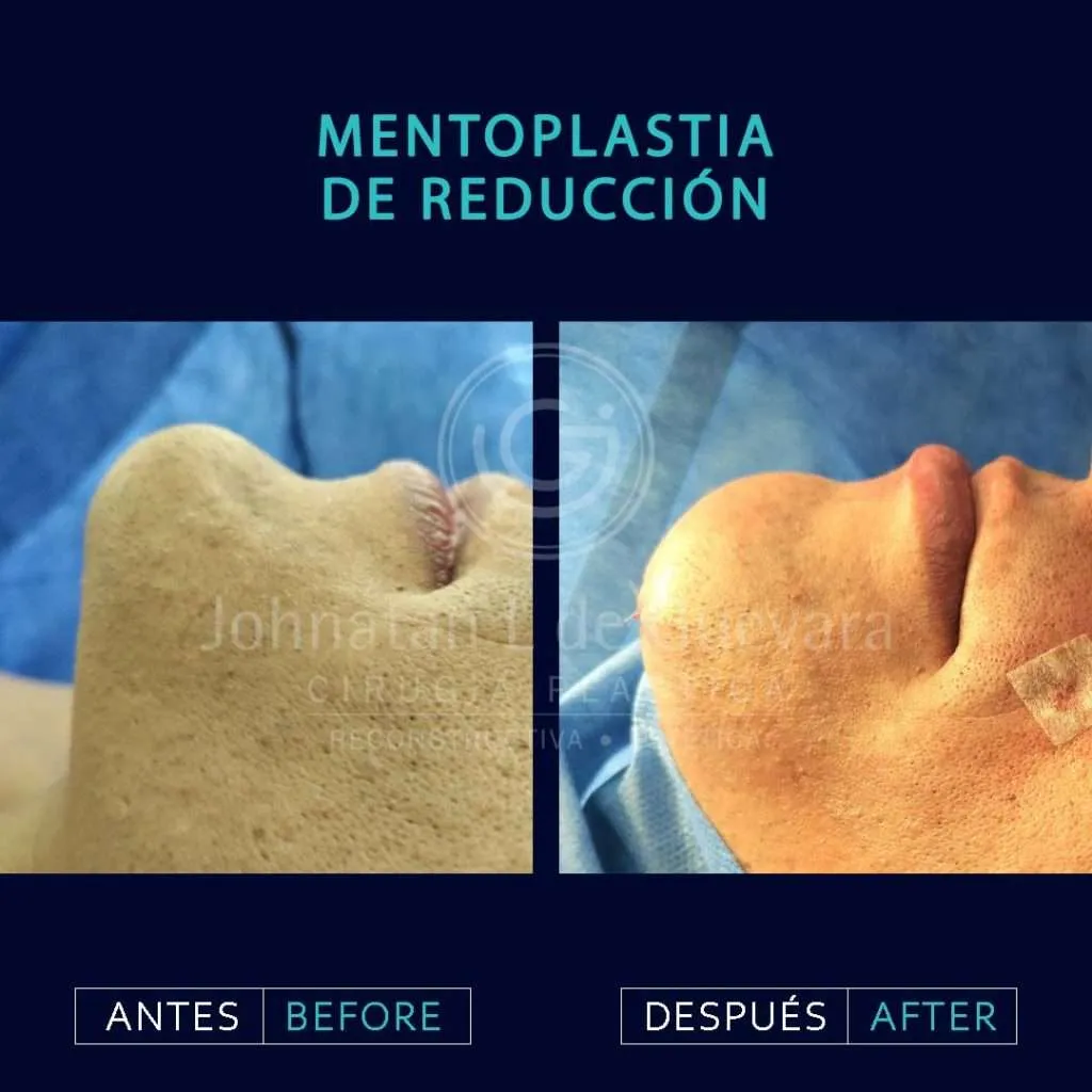 Mentoplasty (Chin Surgery) in Colombia 3 Mentoplastia 1 - Mentoplasty (Chin Surgery) in Colombia
