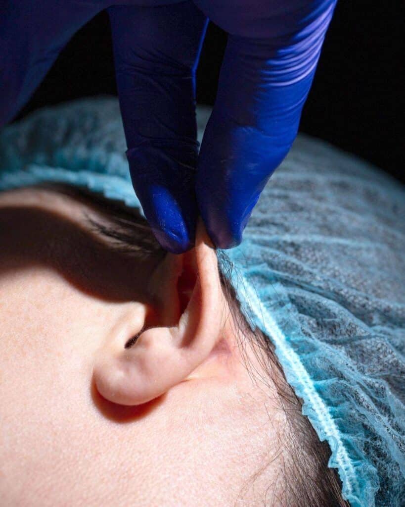 Otoplasty in Colombia 2 Otoplastia A - Otoplasty in Colombia