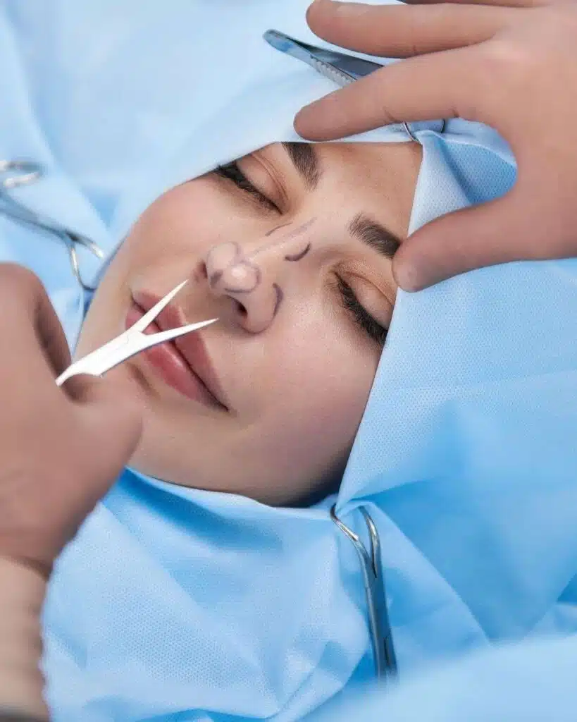 Rinoplastia en Bogotá 2 Rinoplastia A - Rinoplastia en Bogotá